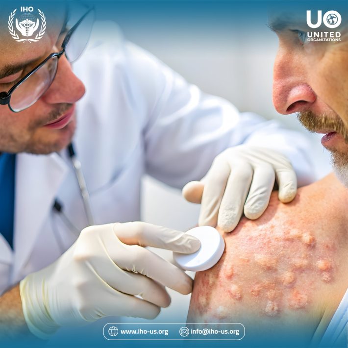 الجرب: دليل متكامل للفهم، العلاج، والوقاية من الحكة المزعجة